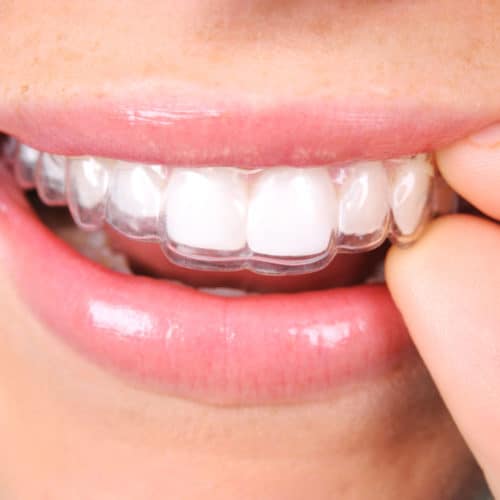 Which is best for you ? Invisalign or Ceramic clear braces - Zen Dental &  Health care